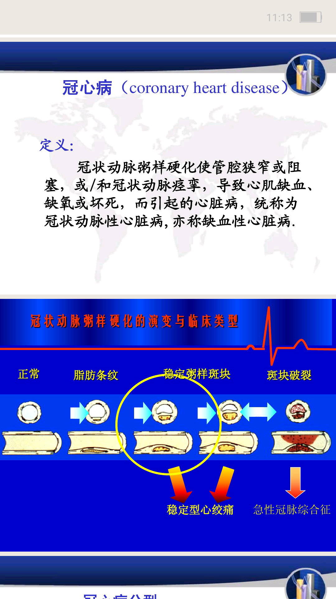冠心病病人的护理查房_护理病人冠心病查房ppt_护理病人冠心病查房总结