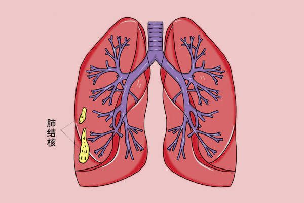 肺症状结核型是什么_三型肺结核的症状_肺症状结核型有哪些