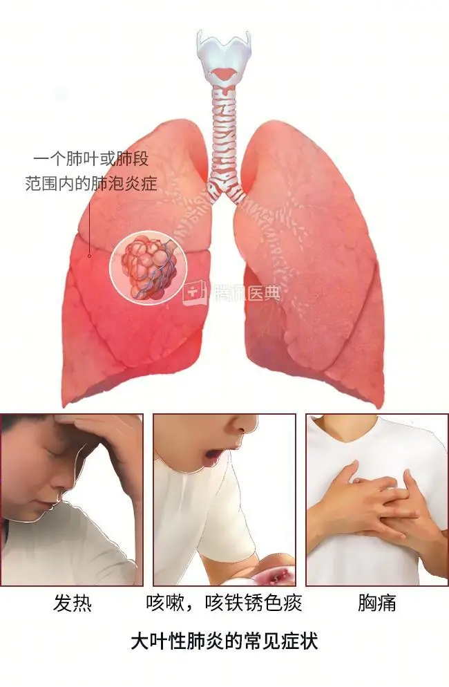 儿童大叶性肺炎的治疗_小孩大叶性肺炎治疗_肺炎治疗儿童大叶性肺炎的药