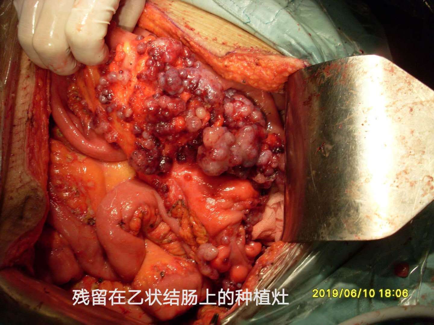 多长手术换药肛瘘时间长一点_肛瘘手术换药多长时间_肛瘘手术多久换药一次