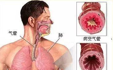 肺气肿的老人双肺感染怎样治疗_老人得了肺气肿后果_老年人肺气肿感染