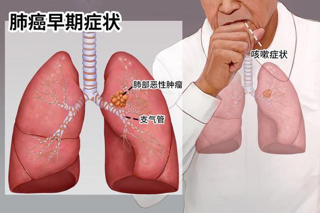 肺早期症状结核是什么意思_肺早期症状结核是肺癌吗_肺结核早期症状是什么