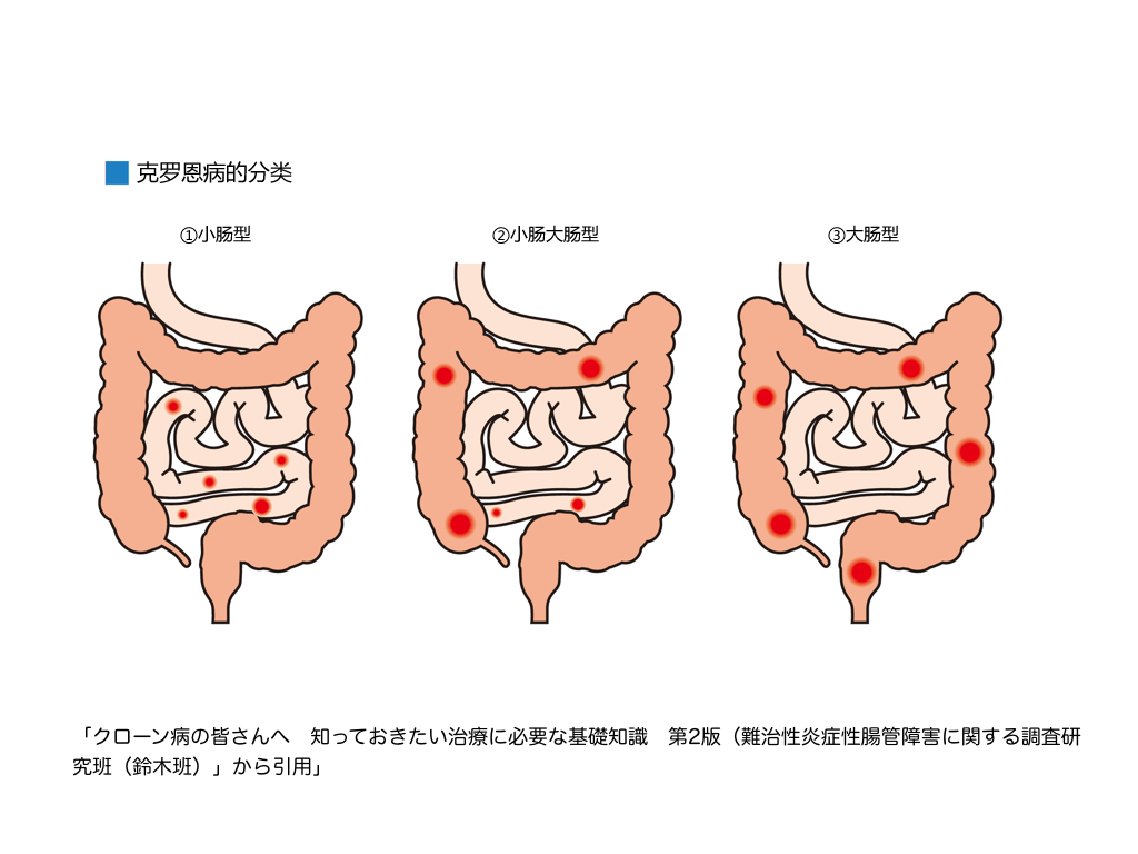 克罗恩病患者的护理ppt_克罗恩护理常规ppt_克罗恩的护理查房