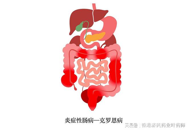 克罗恩的护理查房_克罗恩护理常规ppt_克罗恩病患者的护理ppt