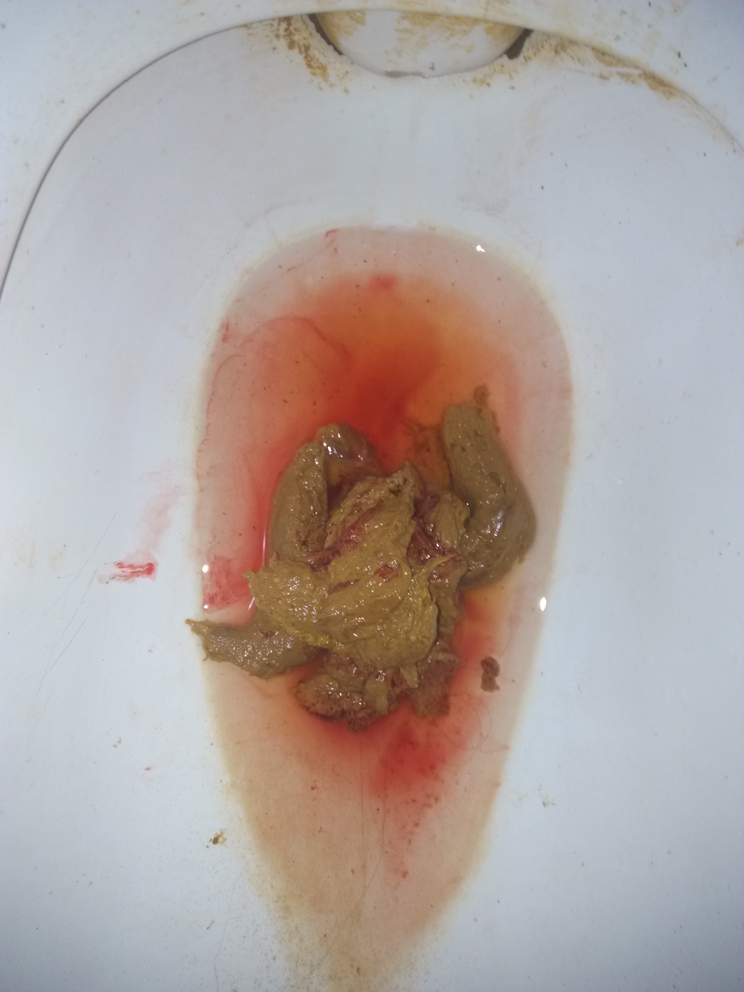 拉大便拉出好多鲜血_拉鲜血大便好多出血_拉屎出鲜血多