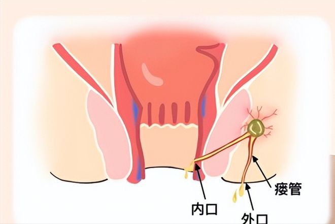 肛瘘手术时间_手术肛瘘时间多久_肛瘘手术时长