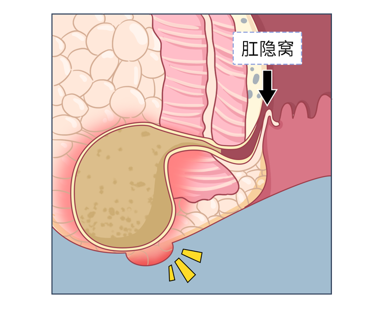 肛瘘手术时长_手术肛瘘时间多久_肛瘘手术时间