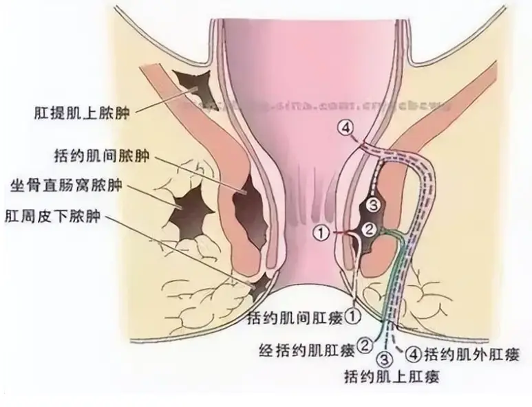 肛瘘手术时间_手术肛瘘时间多久_肛瘘手术时长