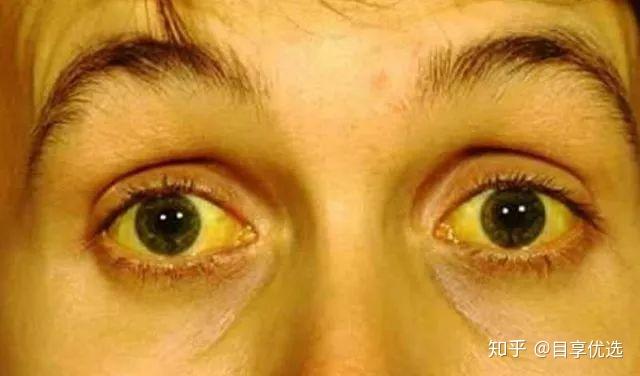 眼球白发蓝是什么原因_眼球回事白发蓝是怎么回事_白眼球发蓝是怎么回事