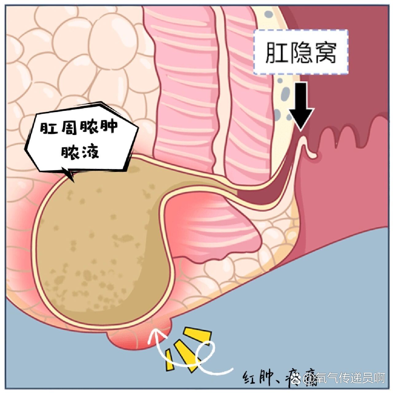 做肛瘘多久可以同房_做肛瘘手术多长时间能同房_肛瘘手术多久能做