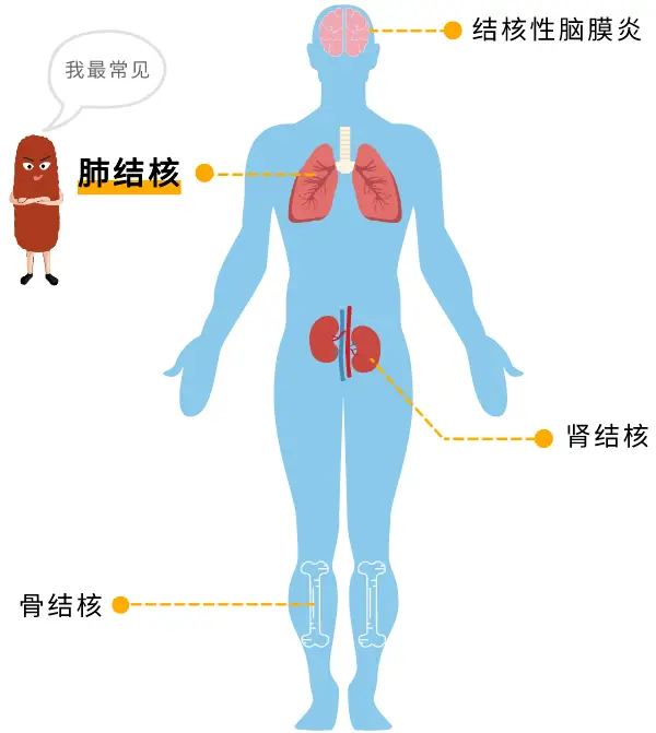 三级肺结核严重吗_肺结核三级会传染吗_三级肺结核能活多久