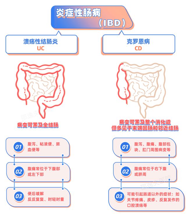 克罗恩病诊断书写_罗克罗恩病的特征性体征_克罗恩病/诊断