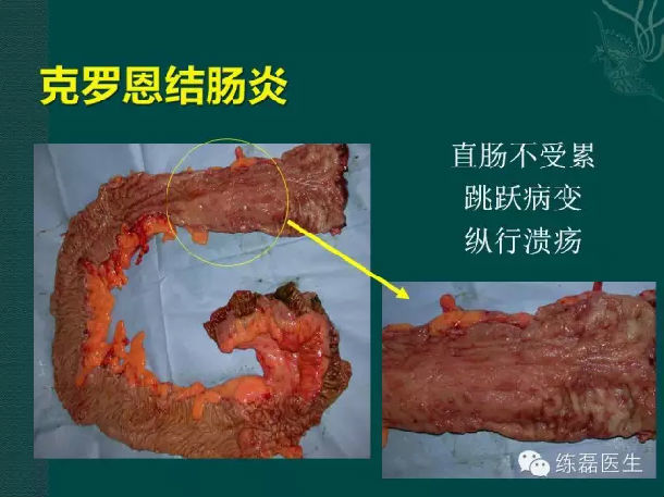 中国有多少克罗恩病人_罗克恩病早期症状_罗克恩是什么病