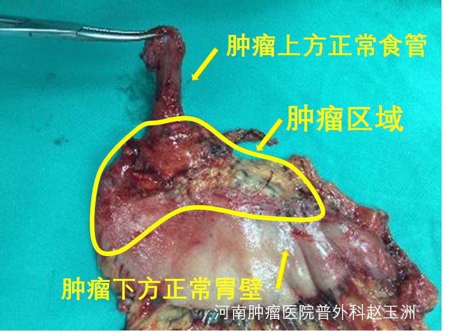 胃癌ct图片大全-胃癌 CT 图片背后的生命挣扎与疾病无情
