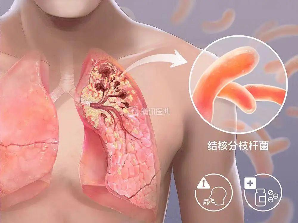 怎样会患上三型肺结核_肺结核会引起其它病吗_结核会引起肺部感染吗