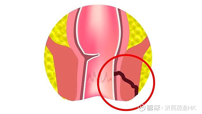 克罗恩病病理诊断要点_克罗恩病的病理特点有_克罗恩病病理学特点