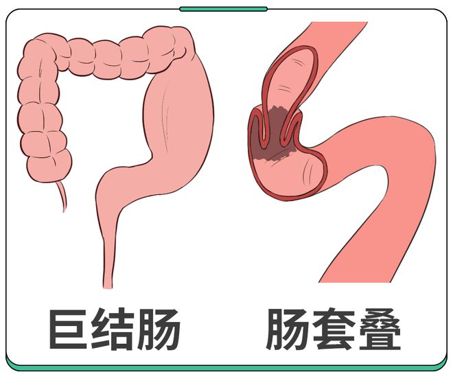 小儿急性阑尾炎护理措施_小儿急性阑尾炎术后护理_小儿急性阑尾炎术后护理
