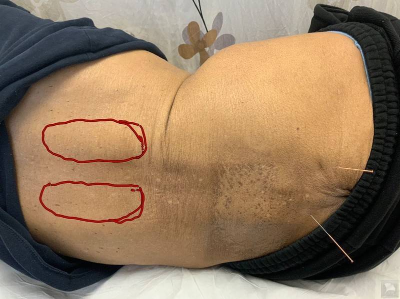 深呼吸后背疼是肺癌吗_后背疼呼吸肺癌是怎么回事_后背疼呼吸肺癌是什么原因