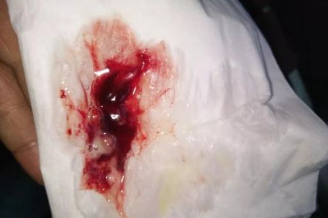 咳嗽后背疼是肺都不好吗_咳嗽后背疼是肺癌吗_想咳后背疼会不会肺癌