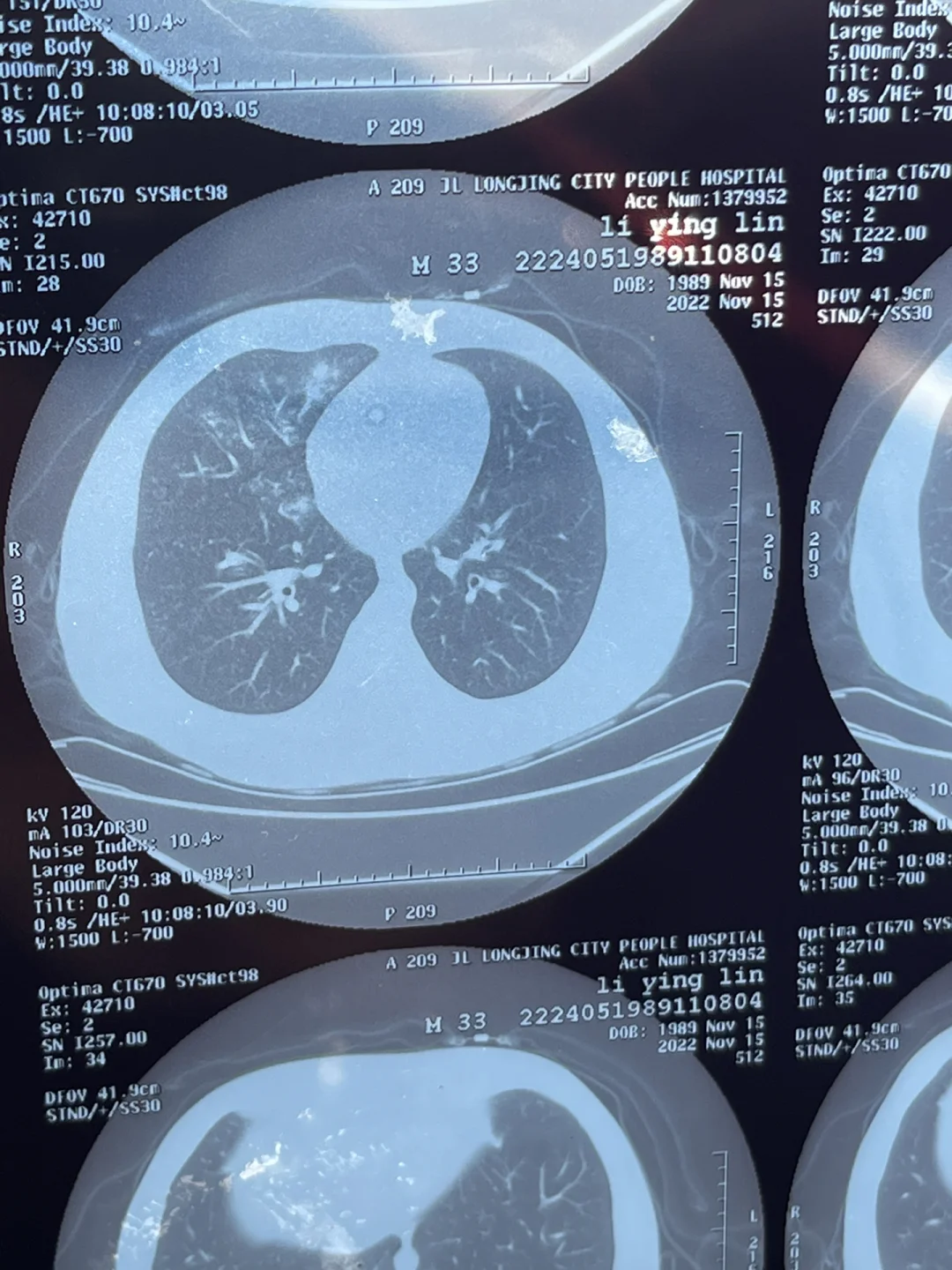 肺上有空洞后，我是如何与命运抗争并重新找回生活的？