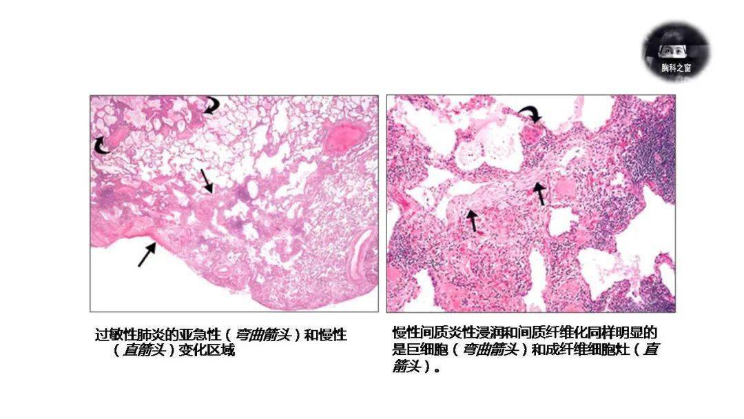 肺泡蛋白沉积：隐形杀手，悄悄夺走呼吸自由