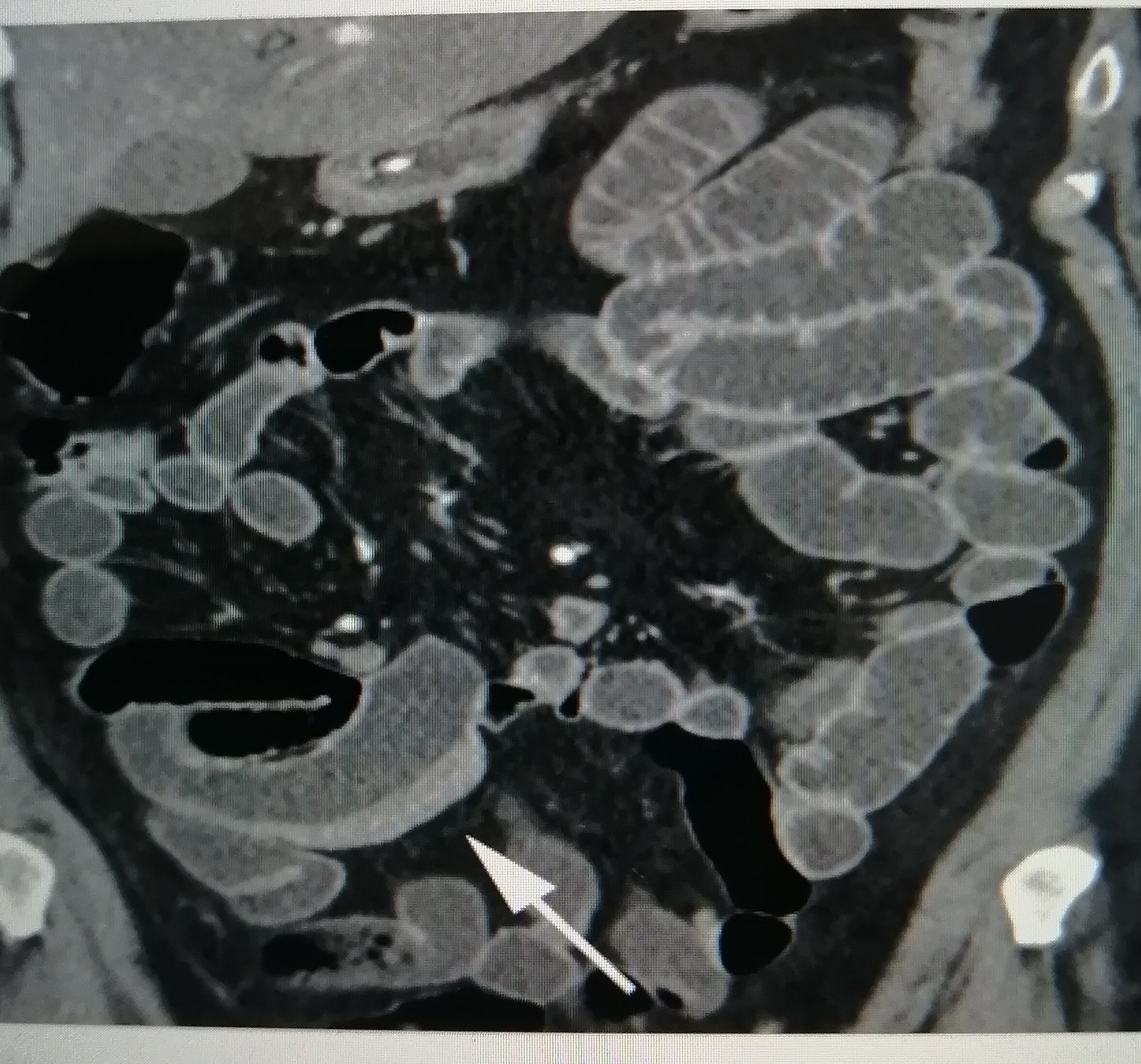 crohndisease_crohn病是什么疾病_crohn