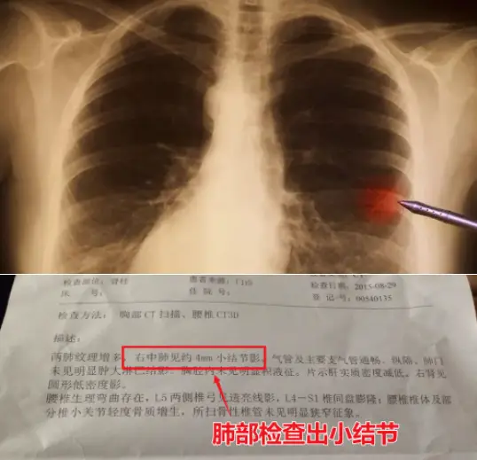 肺ct 白-肺 CT 上的白影，是身体的秘密还是健康的警示？