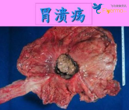 胃中医治疗溃疡效果好吗_中医治疗胃溃疡_胃中医治疗溃疡的方剂