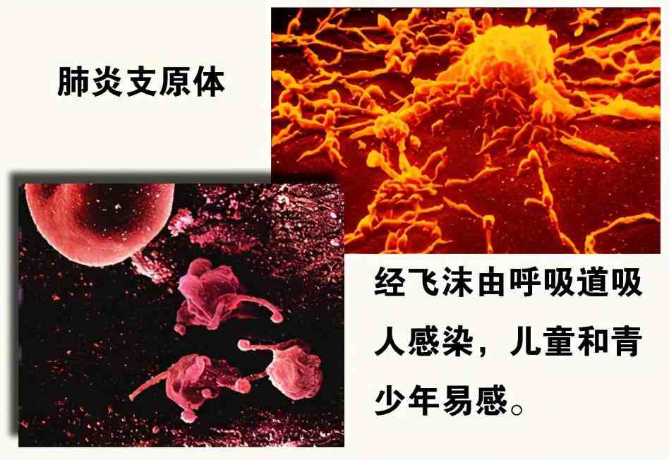 肺炎治疗儿童支原体的药物_儿童支原体肺炎的治疗_儿童肺炎支原体吃药能好吗