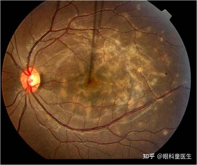 肺结核性继发复发会传染吗_肺结核性继发复发会传染人吗_继发性肺结核会复发吗