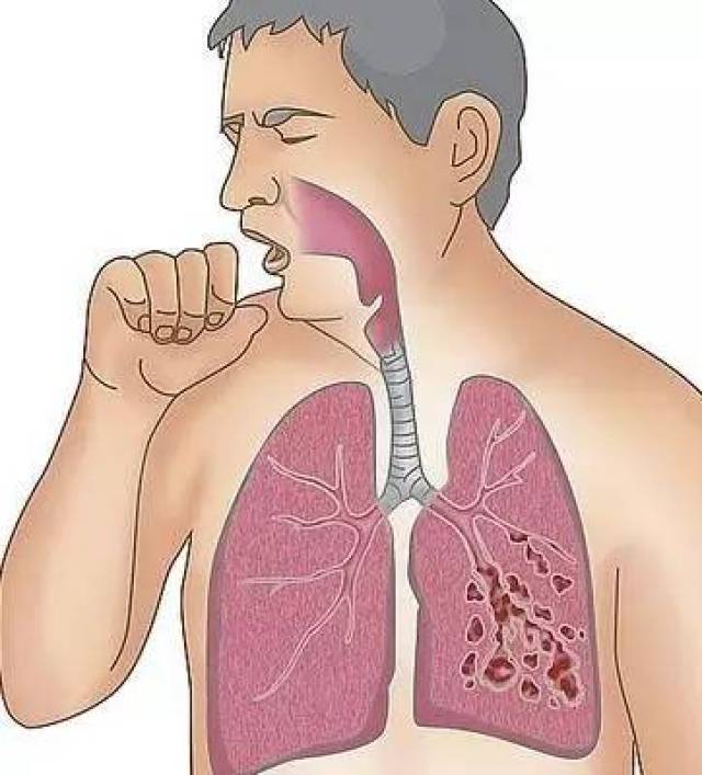 娃儿咳嗽变异性哮喘_咳嗽性变异哮喘儿童_小孩咳嗽变异性哮喘症状