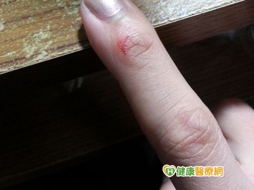 肛瘘手术后伤口长时间不愈合_肛瘘手术后伤口长时间不愈合_肛瘘术后伤口愈合后还会疼吗