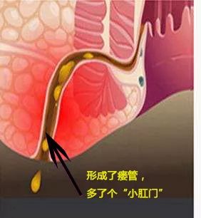 肛裂肛瘘痔疮手术需要恢复多久_肛裂肛瘘手术治疗需要多长时间_肛裂加肛瘘手术