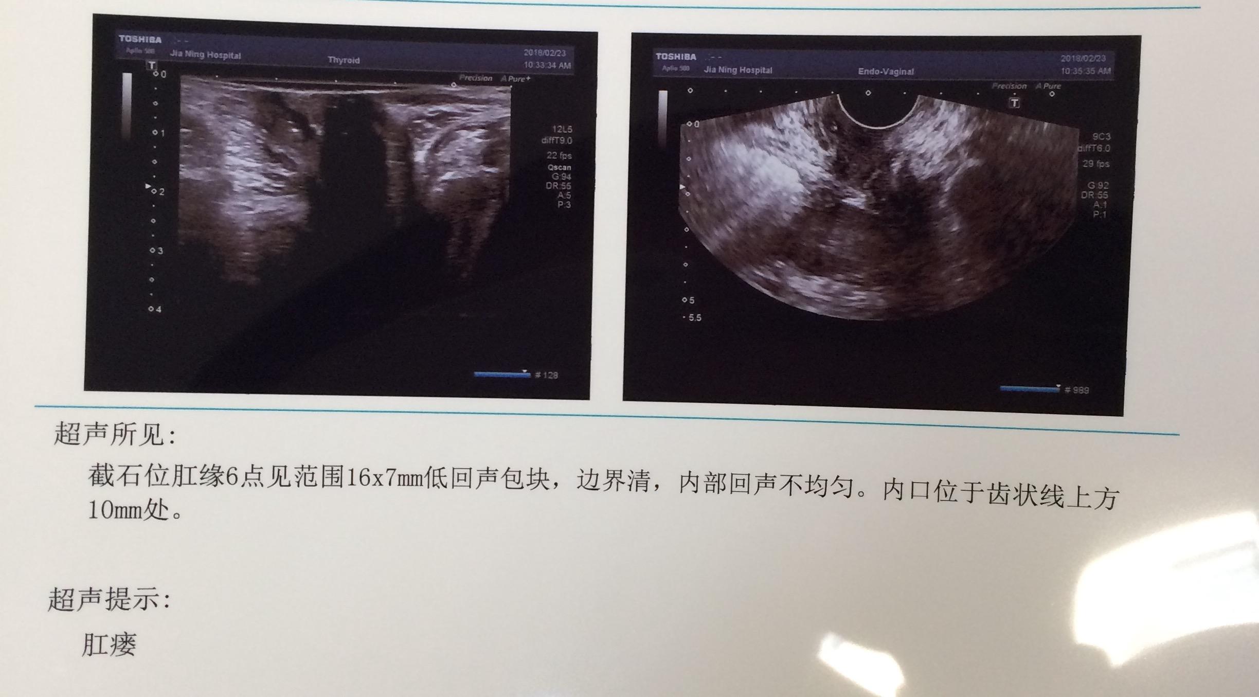 肛瘘手术后多长时间坐浴_肛瘘术后坐浴一次多久_多长手术坐浴肛瘘时间后最好