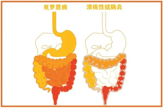 肠炎克罗恩病_克罗恩肠炎_克罗恩肠炎跟一般肠炎的区别