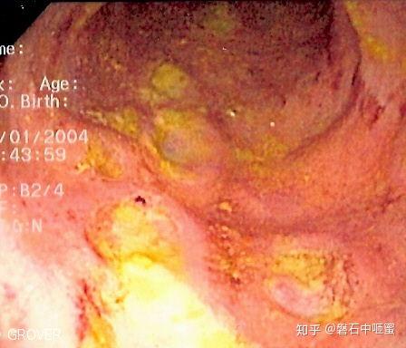 克罗恩肠炎跟一般肠炎的区别_肠炎克罗恩病_克罗恩肠炎