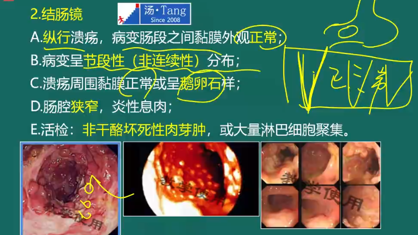 罗克恩病严重吗_课罗恩病_克罗恩病的六大标准