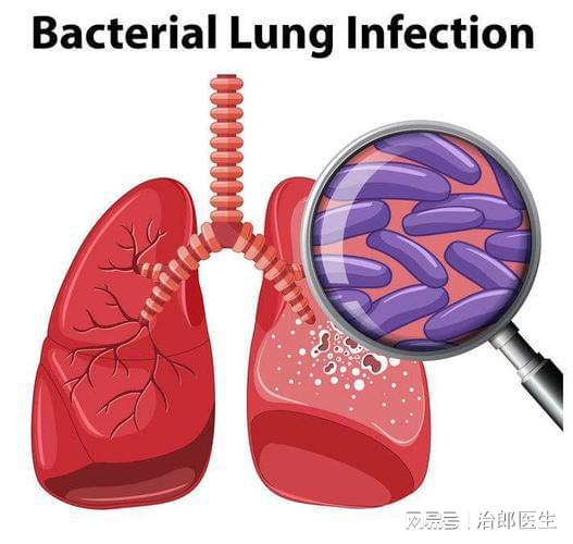 肺早期感染症状结核怎么治疗_感染肺结核早期症状_初期肺结核是什么症状会传染吗