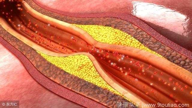 冠心病护理案例分析_家庭冠心病病人的护理案例_一例冠心病患者的护理个案