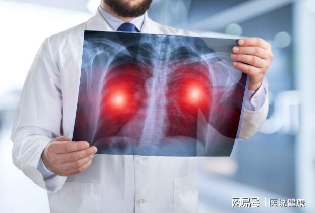 后背疼是肺癌早期还是晚期_肺癌的后背疼什么症状_后背疼是肺癌的可能性有多大