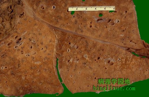 浸润型肺结核严重吗_浸润型肺结核难治吗_肺结核浸润型严重吗