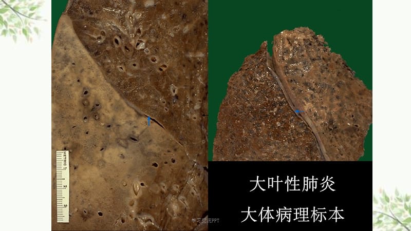 肺炎治疗儿童大叶性肺炎方案_肺炎治疗儿童大叶性肺炎的药_儿童大叶性肺炎的治疗