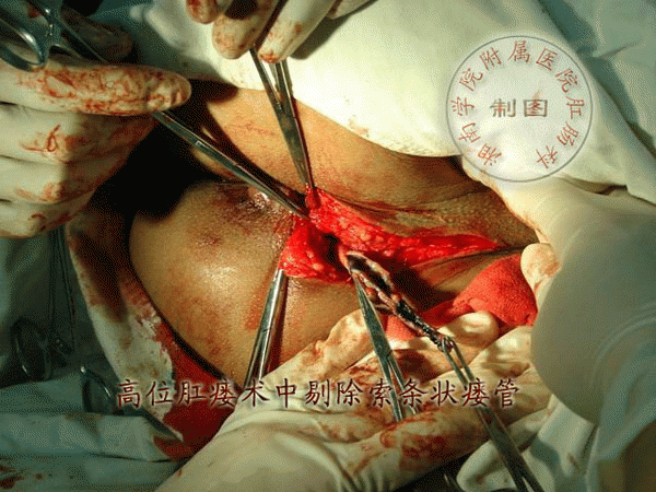 肛瘘手术用多长时间-肛瘘手术：一场让人忍不住皱眉的煎熬之旅
