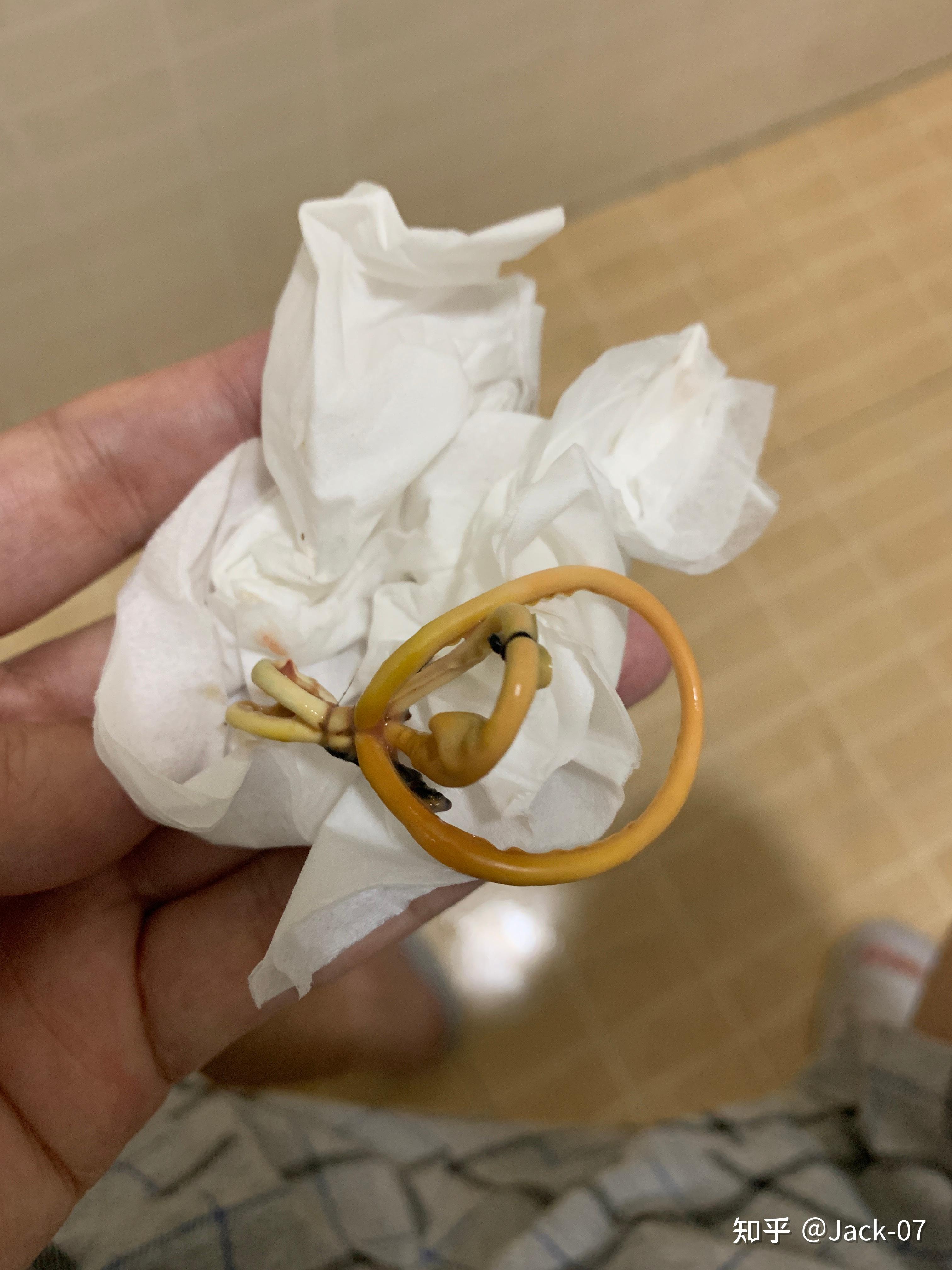 做肛瘘手术一般要多长时间扩肛_肛瘘手术后多长时间才能扩肛_肛瘘手术后多久扩肛门