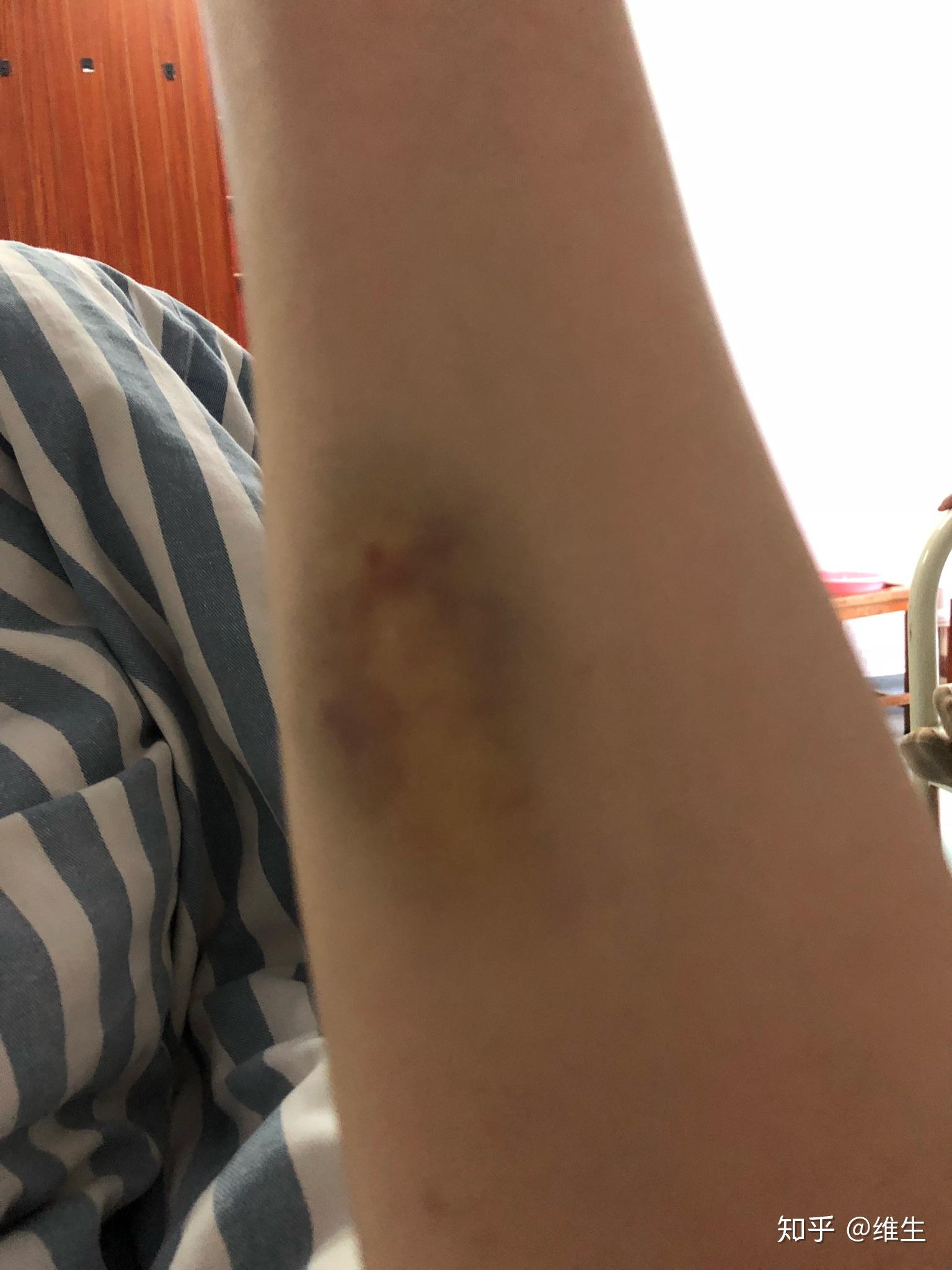 肛瘘手术多长时间能过性生活_肛瘘手术一般多久可以坐_肛瘘手术后多久可以性l生活